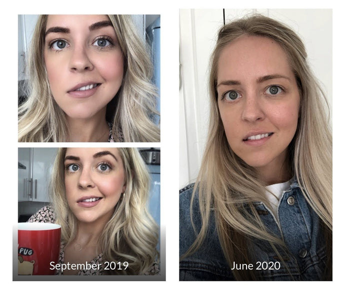 24 Hours Away From Facial Reanimation Surgery